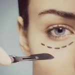 precio de la blefaroplastia